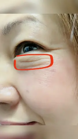 #CapCut Eyes Wrinkles Repair #fyp #darkcircles #welldone #skincare 