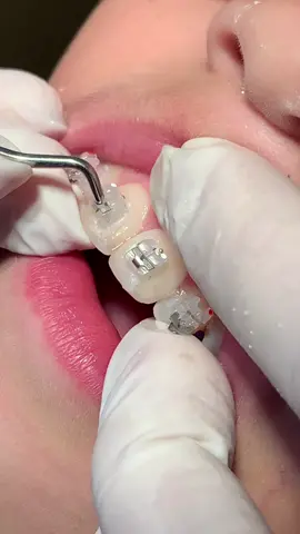 Voces já tinham visto como funciona o aparelho autoligado?  #asmr #sound #aparelho #destista