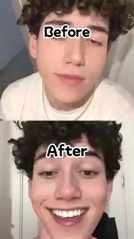 Get a confident and charming smile with SmileKit's teeth whitening strips! Brighten your teeth and boost your confidence with our easy-to-use strips. Try them today!#teethwhitening 