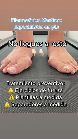 El Hallux valgus se puede prevenir. ☺️#juanetepower #juanetes #halluxvalgus 