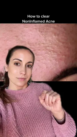 Sto guessing, do this instead #acne #clearskin #blackheads #comedones #breakouts #noninflamedacne #acnejourney #acnepositivity #acneskincare #greenscreen #texture #texturedskin #esthetician 