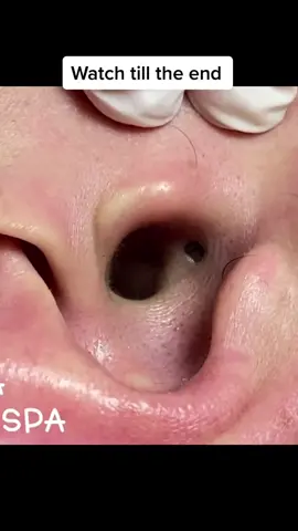 Blackhead inside ear #acne #acneshot #fypシ゚viral #time #tiktok #viralvideo 