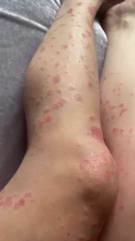 “The body is a miraculous machine” 🫶🏽✨ #Psoriasis is caused by a problem with the #immunesystem, which causes your body to make too many skin cells. you have to fight cell damage from the inside by consuming Anti-Oxidants but there are foods that trigger flare ups such as red meat, dairy and all vegetables from the nightshade family #thepsoriasisdiaries #psoriasis #psoriasisawareness #psoriasiswarrior #psoriasistok #psoriasisjourney #loveyourskin #lovetheskinyourein #holistichealth #holistichealing #veganrecipes #whatieatinaday #fypシ #foryoupage #naturalhealing 