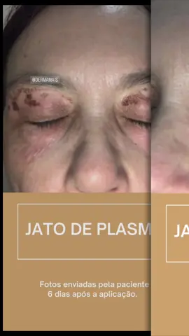 Para quem me pergunta como é a recuperação do jato de plasma. Geralmente a região fica inchada por 3 dias, as casquinhas caem de 3 a 7 dias. Essa foto mostra a paciente no seu 6º dia de recuperação.  #jatodeplasma #blefaroplastiasemcortes #blefaroplastia #flacidezdepalpebras #estetica #esteticafacial #tatuape 