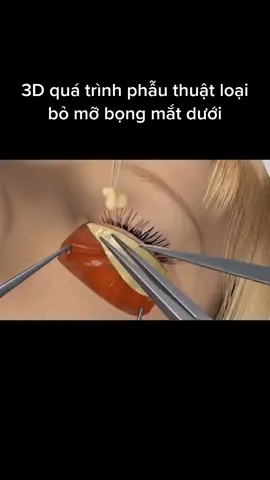 Loại bỏ bọng mắt dưới #pttm #lamdepmoingay #catmi_bocmo 