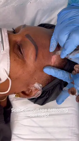#permanentmakeup #pmuartistlip #pmubrow #pmubrows #pmubrowsmiami #camoflaugetattoo #scarcamo #scarcamouflagetattoo #scarcamouflagemiami #miamibrowartist #vitiligo #vitiligocheck #hypopigmentantion #hypopigmentedscars 