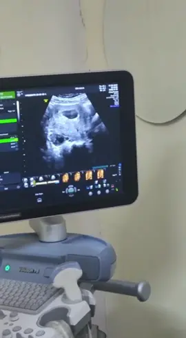 #blightedovum #blightovum #blightobumpregnancy 