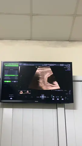 Hạnh phúc nhất mỗi lần đi sưu âm . Nghe nhịp tim mà vui và thổn thức . Thành tâm xin vía bé gái bỏ bụng ah . Các mon tim thai 170 trai hay gái vậy ạ . #10w3d@Hải bánh36 @Vũ Gia Khánh 