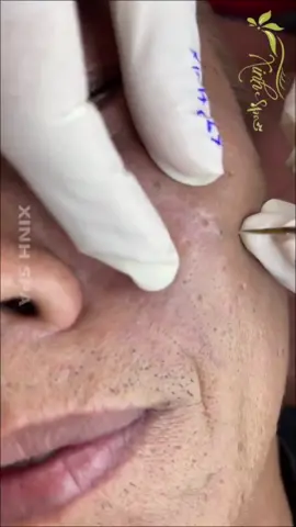 Extremely satisfying  S2 ep 2 Daily Satisfying Blackheads, Pimples, Acne, Whiteheads and Ingrown Hair #pimplepoppersatisfying 