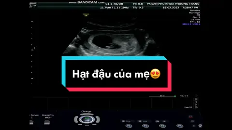 Mới cách đây 2 tuần e chỉ là chấm nhỏ mà h đã to bằng hạt đậu rồi! Hẹn mẹ 2 tuần nữa đến lmf xeta nghiệm sàng lọc Nipt nhé!! 😍#TikTokGiaiTri  #SiêuÂmThai #sieuamphuongtrang #drcuongspk #xnnipt #sangloc #sieuamthai #sieuam2d 