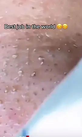 #noseextractions #whiteheads #skincare #oilyskin #oilypores #satisfyingvideo #squeezepip #viralvideo #foryou 