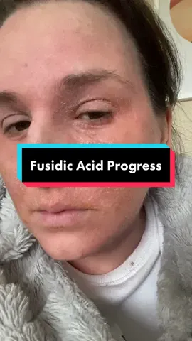 Day 5 of fusidic acid has severely reduced my symptoms! Still quite yellow and crusty, but i didnt expect to be fully healed. Being referred to dermatology soon to discuss immunosuppressants! 🤞🏻 #topicalsteroidwithdrawal #eczemaawareness #tsw #fyp #fypシ #tsw #topicalsteroidaddiction #topicalsteroidawareness #skincareawareness #skinawareness #eczema #eczemaawareness #viral 