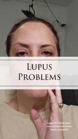 Lupus is a very complicated illness and it's different for everyone. I want to share some of the struggles that I go thru in hopes that I can reach someone that is going thru the same thing and they know they are not alone.  I get huge sores/ulcers in my mouth. This time it was on top of my front tooth. It's excruciating to brush my teeth.  Do u get sores/ulcers in ur mouth? Let's share and create a community. . El lupus es una enfermedad muy complicada y es diferente para todos.  Quiero compartir algunas de las luchas por las que paso con la esperanza de poder llegar a alguien que esté pasando por lo mismo y que sepa que no está solo. Me salen grandes úlceras en la boca.  Esta vez estaba encima de mi diente frontal.  Es insoportable cepillarme los dientes. ¿Tienes úlceras en la boca?  Compartamos y creemos una comunidad. #lupus #lupusfatigue #lupussucks #lupusawareness #lupuswarrior #chronicillness #chronicpain #illness #latina #boricua #chronicillnesswarrior #autoimmunewarrior #autoimmunewarriors #lupuswarriors #chronicillnesswarriors #chronicillnessawareness #autoimmuneawareness #slelupus #lupussle #lupussupport #chronicillnesssupport #autoimmunesupport #lupusproblems #chronicillnessproblems #autoimmuneproblems #chronicallysick #lupuslife #mylifewithlupus #lupuscommunity #chronicillnesscommunity 