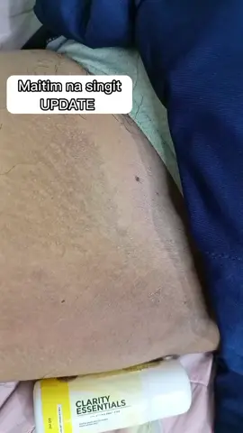 Maitim na singit! UPDATE 😍😍 #yellowpeelingoil #clarityessentialsyellowpeelingoil #clarityessentials #clarityessentialsinguinalwhiteningcream #inguinalwhiteningcream #dark #darkspots #skincare #try #fyp #fypシ #fypage 
