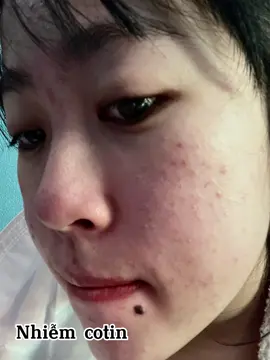 1 quá trình rút ngắn time với nhà #meea thì làn da như được hồi sinh #thohuynhdieutrida #thohuynhmeeaorigin #peeltaosamboctachnam #trumtrimun #trimunthamnamhieuqua #cotthaoduoc🌿 #caomun #lamdepmoingay #thohuynhbeauty 