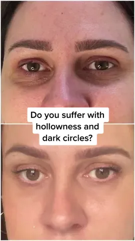 AMI EYES in action! Look how amazing the before and after is! 😍 #amieyes #darkcircles #hollowundereyes #darkeyecircles #eyeconcealer 
