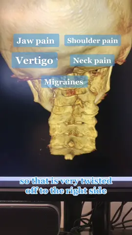 Severe stresss in neck shown on 3D imaging. Is there a kink in your neck?! Check out this 3D image of a patient with a severe upperneck misalignment. #vertigo #jawpain #migraine #frozenshoulder #neckpain #uppercervical #chiropractic 