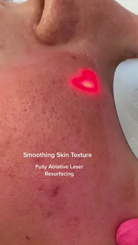 Fully ablative #laser Resurfacing #skintexture #LearnOnTikTok #dermatology #skinbydrazi  