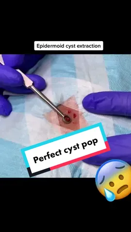 Epidermoid cyst removal. #cystpopping #pimplesquad #SatisfyingThings #oddlysatisfying #pimpletiktok #blackheadsremoval #cystpopping #cyst 