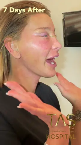 Love it love it love it 😍  Another miracle 👨🏼‍🎨 I performed Deep plane #scarlessfacelift ‼️ #necklift with repairing plastyma muscle, and #blepharoplasty #bichectomy #temporallift #browlift #nanofatgrafting and 4 different laser technologies which are #laserskintightening #fractionalco2laserresurfacing #Qswitchlaser #CCLlaser and plus #revisionrhinoplasty 💪 Moreover I performed #abdominoplasty and #fullbodyliposuction for her 🚀  Furthermore @dt.mervetas performed her teeth 🦷 as well 🤩  She was 60 but new her is just 18 🌈  I told my lovely patient that we should change your birthday date 🥳 A new life is waiting for us 🍀 #bestplasticsurgeon #drsuleymantas #tashospital #bestplasticsurgeryhospital