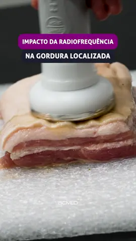 Descubra o segredo para uma pele perfeita! Fizemos uma simulação com a tecnologia de radiofrequência da HTM, onde você pode ter uma redução da gordura localizada e uma pele mais firme e suave logo após as primeiras sessões. Além disso, o tratamento é não invasivo, indolor e possui eficácia comprovada, estimulando a produção de colágeno para um resultado ainda melhor.  Invista agora mesmo no tratamento que vai transformar a pele dos seus clientes! Entre em contato conosco e adquira já a radiofrequência HTM, tecnologia de ponta para o seu negócio.  #HTM #estética #peleperfeita #procedimentosesteticos #colágeno #gorduralocalizada #tratamentoinovador #beleza #bemestar 