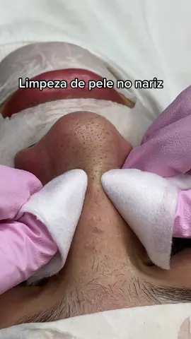 O lugarzinho dolorido 🤭 kkkk  #cravoseespinhas #videosatisfatorio #limpezadepele #cravo #satisfyingvideo #pimple #blackheadpimple 