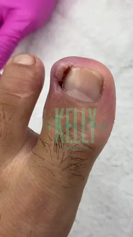 High precision ingrown toenail surgery! Thank you Kelly! 👣 #ingrowntoenail #ingrownnail #ingrown #ingrowntoenailremoval #footpain #fyp #ingrowntoenailsurgery #stubborn #granuloma  #satisfying #relaxing #viralvideo @FootWorks Relaxing 