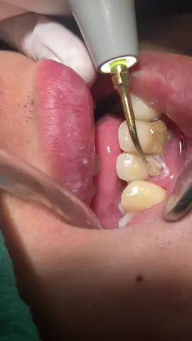 #scalingteeth🦷 #calculusremoval #ultrasonic#ptconsent✅🔱sapteshwor_dental 