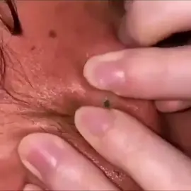 What a big blackhead  #pimple #acne #pimples #blackheads #pimplepopping #skincare #blackhead #pimplepopper #whiteheads #pimplepoppers #whitehead #blackheadextraction #blackheadremoval #cyst #pimplepop #drpimplepopper #pimplesremover #zit #pores #skin #whiteheadextraction #drsandralee #beauty #acnetreatment #cystremoval #zits #whiteheadremoval #jerawat #skincareroutine #pimpleremover