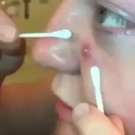 Big pimple pop #pimple #acne #pimples #blackheads #pimplepopping #skincare #blackhead #pimplepopper #whiteheads #pimplepoppers #whitehead #blackheadextraction #blackheadremoval #cyst #pimplepop #drpimplepopper #pimplesremover #zit #pores #skin #whiteheadextraction #drsandralee #beauty #acnetreatment #cystremoval #zits #whiteheadremoval #jerawat #skincareroutine #pimpleremover