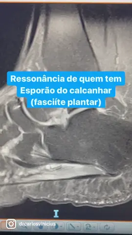 Ressonância de quem tem esporão do calcanhar (fasciite plantar). Veja também os tratamentos dessa doença. Dr Carlos Vinícius - CRM 140189 #drcarlosvinicius #ortopfit #ortopesporte #tratamento #esporao #fasciiteplantar #dornocalcanhar 