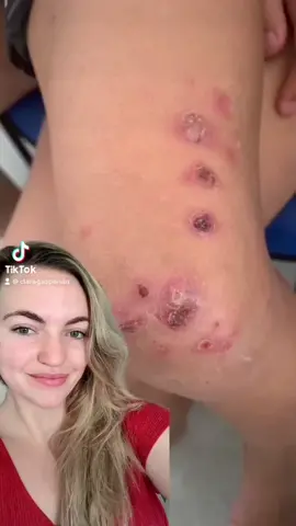 Impetigo: alguem ja teve? #medicina #ubs 