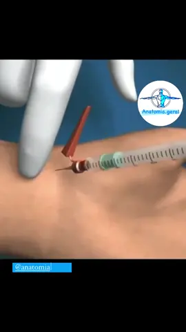 Punção Arterial A punção arterial é indicada quando há necessidade de monitorização contínua da pressão arterial em pacientes com grave instabilidade hemodinâmica, para coleta frequente de amostras sanguíneas em pacientes em ventilação mecânica e, também, para administração de drogas intra-arteriais. A gasometria sanguínea arterial é um exame realizado a fim de avaliar a capacidade pulmonar de duas maneiras, quanto à proporção adequada de oxigênio e a remoção do dióxido de carbono; também avalia-se a capacidade dos rins do indivíduo, observando a reabsorção ou excreção dos íons de bicarbonato para manter o pH corporal normal.  A coleta da gasometria arterial é realizada por meio de uma punção arterial, normalmente na artéria radial, braquial ou femoral. É uma técnica asséptica, a fim de prevenir infecções. Antes de realizar a punção arterial, deve realizar o teste de Allen. Se o teste for negativo ou houver ausência ou lentidão do preenchimento sanguíneo da mão, deve-se escolher outro local. O teste de Allen anormal pode ser causado por um trombo, um espasmo arterial ou um problema sistêmico, como choque ou débito cardíaco diminuído. Aproveita salva esse vídeo e compartilha com seus amigos! 😉 #enfermagem #puncaoarterial #gasometriaarterial #gasometria #urgenciaeemergencia #urgencia #emergencia #emergência #técnicoemenfermagem #nurse  #fisioterapia #fisio #fisioterapeuta #ag♿️ 