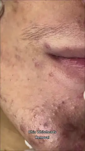 #satisfying #blackhead #blackheads #Acne #Pimple #pimplepoppersatisfying 