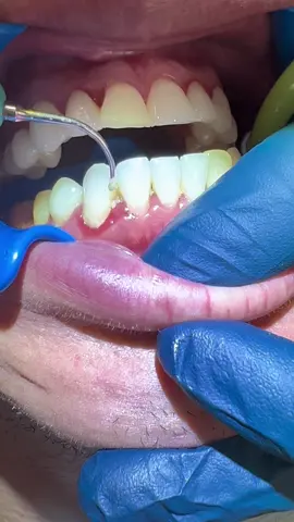 Gingivitis: red, swollen and bleeding gums caused by poor hygiene #limpiezadental #dentalhygienist #satisfying #odontologo #gingivitis 