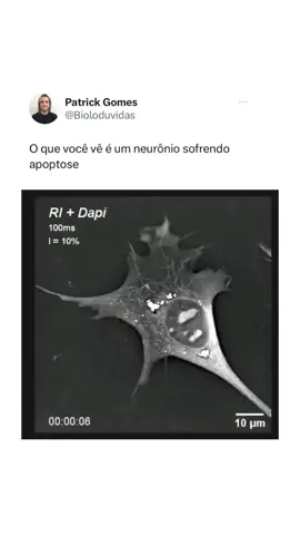 Neurônio sofrendo Apoptose! #neurociencia #neuronio #anatomia #anatomy 