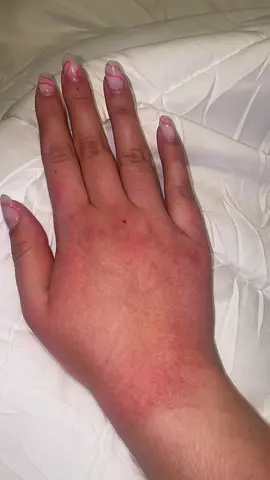 What is this?! Helpppp #Stitch #foryoupage #fyp #hand #eczema #rash #allegicreaction #dry #winter #utah #snow 