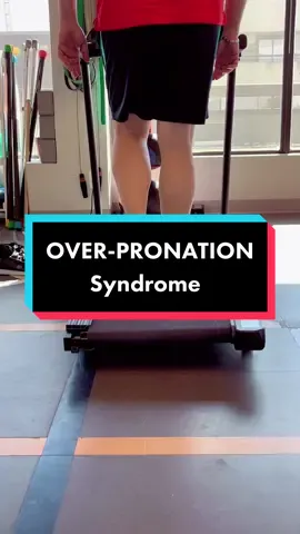 Over-pronation syndrome can cause conditions such as plantar fasciitis, Achilles’ tendonopathy, heel pain, arch pain, cause hallux valgus and bunions, shin splints, metatarsal pain, knee pain. #overpronation #plantarfasciitis #achillestendonitis #heelpain #archpain #halluxvalgus #bunions #metatarsal #orthotics #fyp  @QubeCore Sports & Rehab 