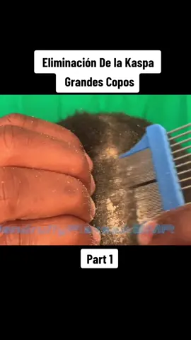 eliminación de la caspa grandes copos #caspa #dandruff #fyp #foryou #dandruffremovel #satisfying 