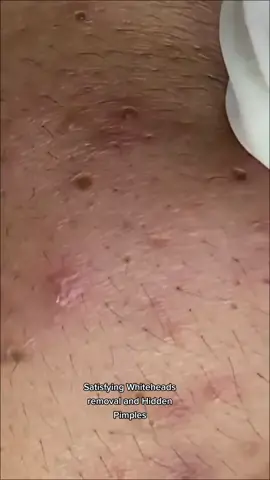 #pimplepoppersatisfying #Pimple #Acne #blackheads #blackhead #satisfying 