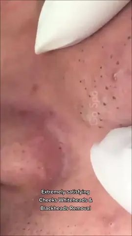 #satisfying #blackhead #blackheads #Acne #Pimple #pimplepoppersatisfying 