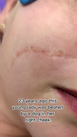 #foryou  @DermapenWorld  #scarmicroneedling  #beforeandafter 
