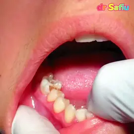 How To extract first MOLAR by Using forceps#support #tiktok #newaccount💔 #drsafiu #viral #video 