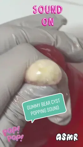 ASMR pop sound ! Gummy Bear Cysts popping ! #asmr #fyp #asmrvideo #gummybears #gummybearchallenge #satisfying #mochipopping #pimplepop #satisfyingvideo 