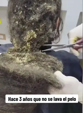 Hace 3 años que no se lava el pelo #fyp #foryou #dandruff #caspa #phobia 
