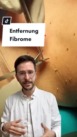 👨‍⚕️ Unser Dr. P erklärt: Fibrome oder Stielwärzchen (Schwäbisch, Deutsch: Stielwarze). #fibrom #stielwarzen #warze #hautarzt #hautarztperapp #hautarzterklärt #haut #hautpflege #hautpflegetipps #hautpflegeroutine #hautpflegetrends #hautproblem #gesichtspflege #gesundheit #skintok #fy #fyp 