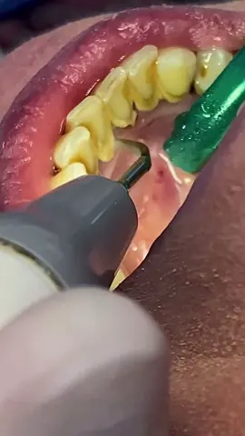 Igiene dentale professionale tramite strumento ad ultrasuoni #dentist #satysfying #igienedentale #tartaros_team #scaling 