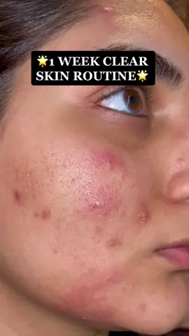 My clear skin routine✨ #foryoupage #foryou #trending #skin #skincare #clearskin #acne #acneskin #asiangirl #desi 