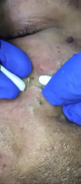 ASMR blackheads 🔴❤️😱#asmr #shorts #short #shortvideo #blackheads #pimplepopping #pimplepopping #blackhead #heads #extraction #skincare #asmr #animation ,#애니메이셔ᄂ치료 이션,#스톱모션 션,#ASMR , #BugRemoval ,#MultiWounds ,#GraphicContent ,#ExtremeASMR ,#Satisfying ,#ShiverInducing ,#Shorts ,#MushroomASMR68 ,,#ASMRvideo,#ASMRcommunity ,#ASMRexperience ,#ASMRchallenge ,#ASMRrelaxation,#ASMRmassage ,#ASMRvisuals ,#ASMRhealing ,#ASMRstimulation ,#asmrfantasy ,#ASMRsleep #sleep #treament #shortstory #shortstories #shortvideos #blackheads #pimplepopping #pimplepopping_addiction #pimplesandblackheads #extraction #skincareroutine  #asmrasmr #animationmeme , 애니메이션스톱모션,#ASMR ,#BugRemoval , #multiwounds #GraphicContent #ExtremeASMR #Satisfying , #shiverinducing #shortstories ,#MushroomASMR ,#skincaretips #ASMRvi #ASMRcommunity , #experience ,#ASMRchallenge ,#ASMRrelaxation ,#ASMRmassage ,#ASMRvisuals #ASMRhealing ,#ASMRhealing #mentalstimulationfordogs , ,#asmrfanpage #asmrsounds #asmrtiktoks #tiktok #tiktokindia #asmranimation #스톱모션 #스톱모션