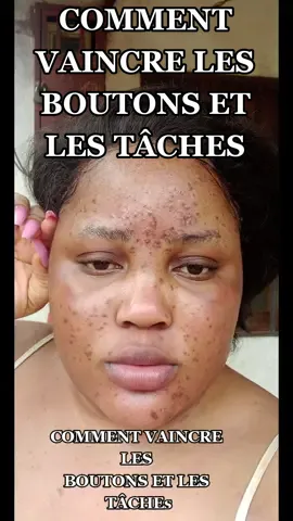 COMMENT VAINCRE LES BOUTONS ET LES TÂCHES #skincare #skincareroutine #traitementacne #soins#curcuma#miel,#boutons#traitementboutons #peau #taches 